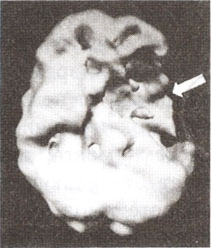 Инсульт в левой фронтальной доле. Трехмерное  изображение — нижняя  поверхность.