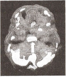 Глубокая лимбическая система, трехмерное изображение снизу — активный  мозг.