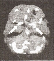 Мозг Билла — мозг влюбленного  человека, трехмерное изображение — активный мозг,  вид снизу.
